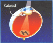 Eye with Cataract