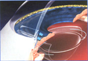 Intra Ocular Lens Implant