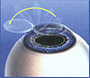 Keratome/Corneal Flap Creation